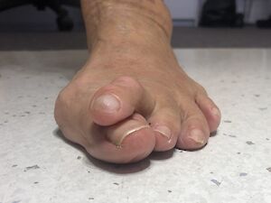 Hammer toes